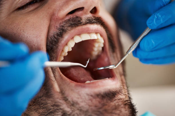 Best Emergency Dentist for Lost Fillings or Crowns in University Of Lifornia Davis, CA