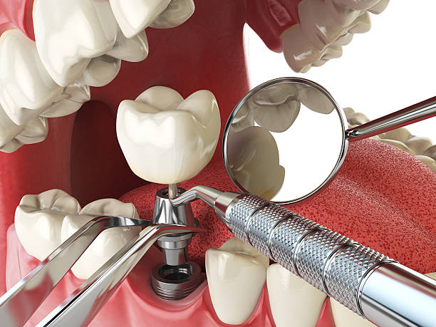 Best Emergency Dental Care for Abscessed Tooth in University Of Lifornia Davis, CA